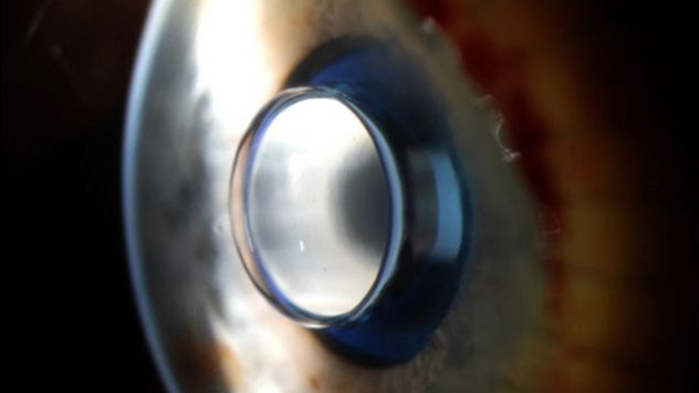 A closeup of the telscope implanted in Dorothy Bane's eye