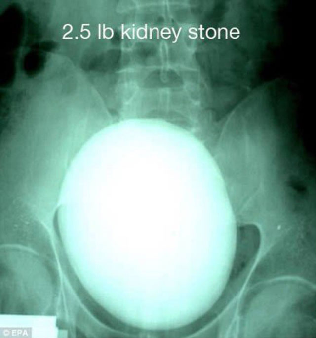 giant kidney stone