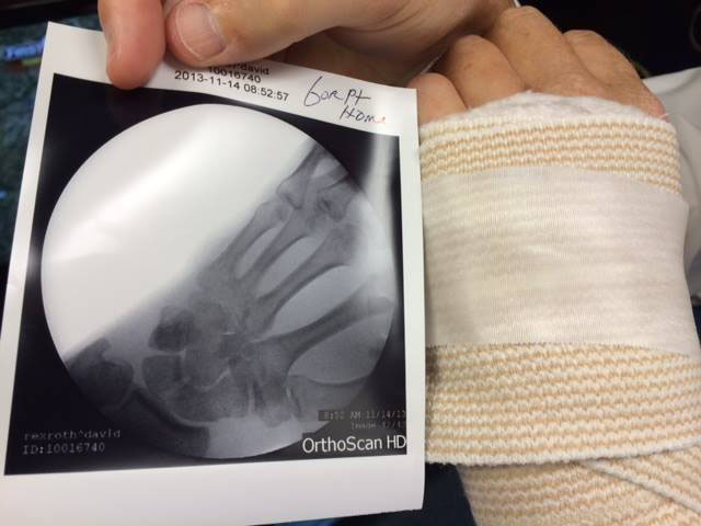 dave rexroth, injury, hand, x-ray, eye