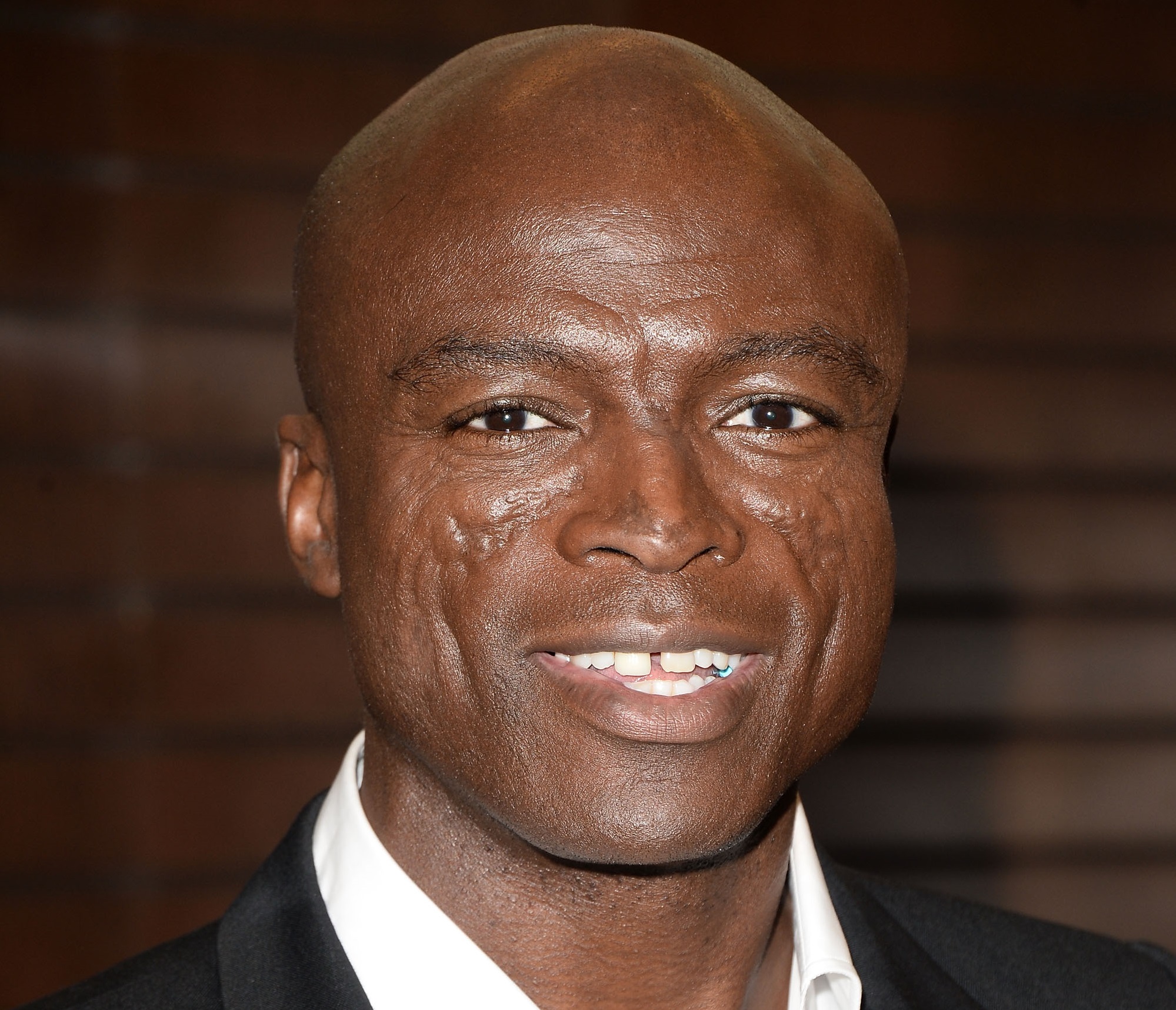 Musician Seal Face Scars, Seal Face Scarring, Discoid Lupus Erythematosus, What Happened to Seal's Face, Seal Face Scars Caused By, Was Seal Burned
