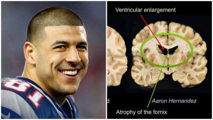 Aaron Hernandez & CTE: Photos Show Severe Brain Damage