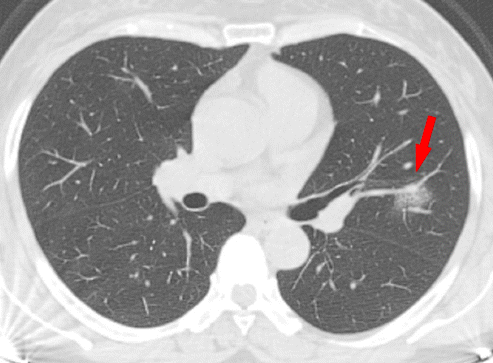 lungs pneumonia ggo mucus inflamed shortness harder