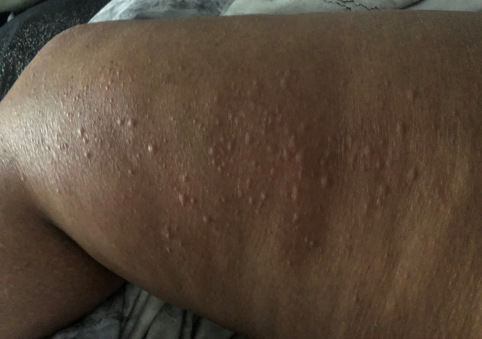 Covid 19 Symptoms Three Skin Rashes To Look For
