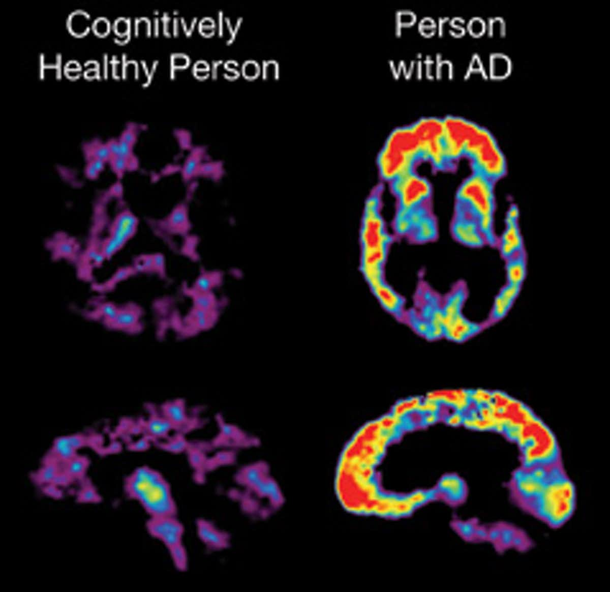 Aducanumab: The FDA’s Big Gamble On The New Alzheimer’s Drug