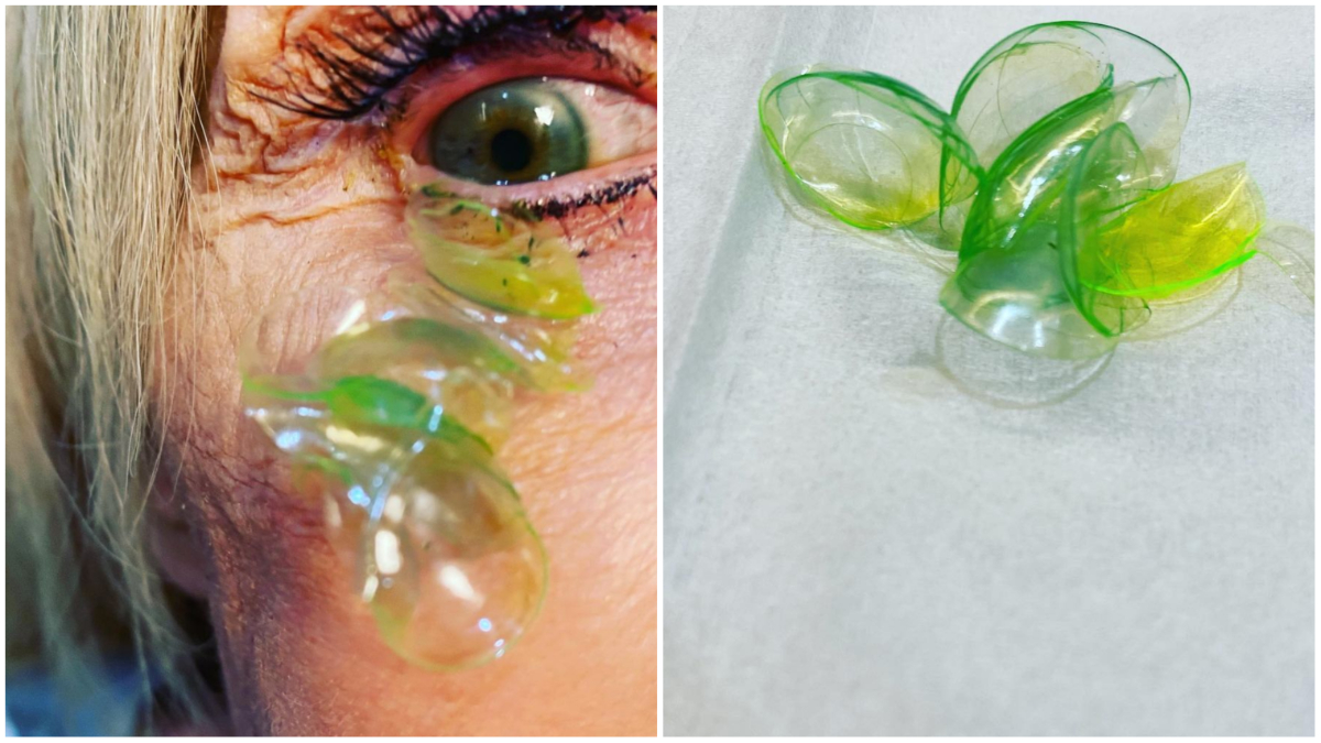 Watch 23 Contact Lenses In Eye Video Goes Viral 8118